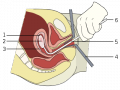 320px-Vacuum-aspiration (single).svg.png